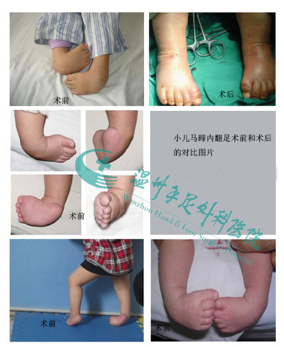 小儿马蹄足内翻术前和术后对比