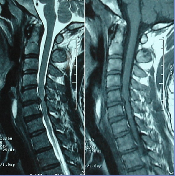髓型颈椎病治疗前和治疗后核磁共振成像